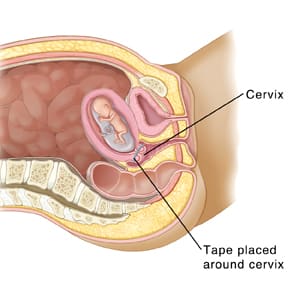 Cross section of pelvis showing baby developing in uterus with band around cervix to hold it closed.