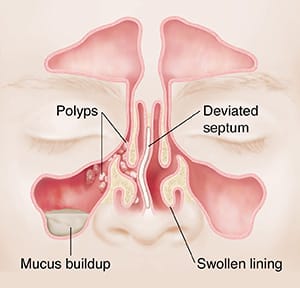 Front view of sinuses with polyps, mucus buildup, deviated septum and swollen lining.